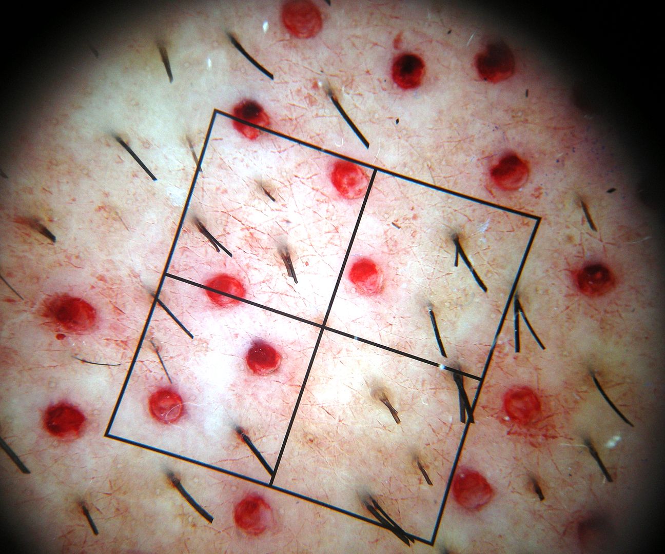 Chest Hair FUE as donor for the Scalp Hair Restoration Questions and